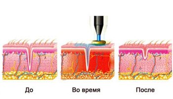 Радиочастотный RF-лифтинг 1
